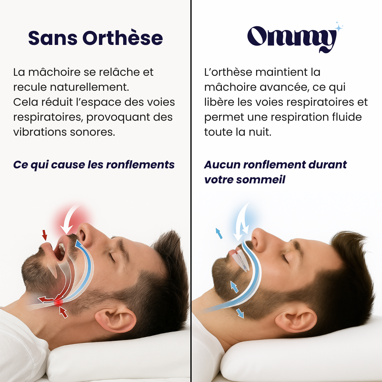Orthèse d’avancée mandibulaire anti-ronflement